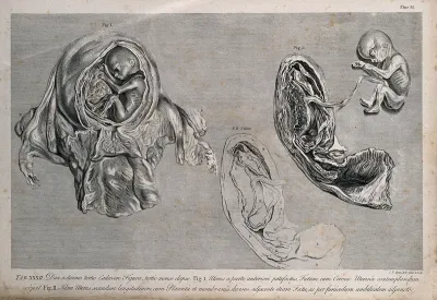 Dissections of the pregnant uterus at three months, showing the foetus in the uterus and a section of the placenta and uterus, with the foetus attached by the umbilical cord: three figures, including an outline diagram