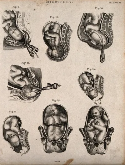 Eight diagrams illustrating babies in the womb in different positions about to enter the world