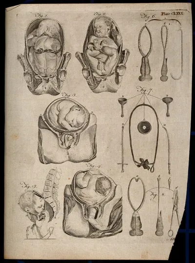 Eight diagrams illustrating difficult births and obstetrical instruments