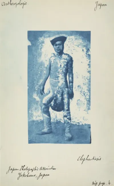Elephantiasis