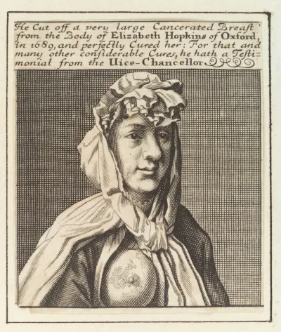 Elizabeth Hopkins of Oxford, showing a breast with cancer which was removed by Sir William Read