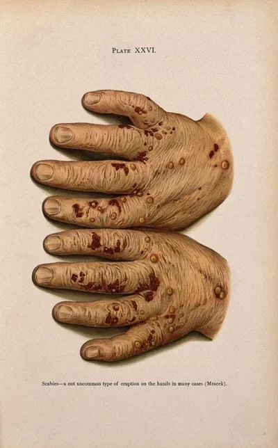 Eruptions on the hands of a patient suffering from scabies