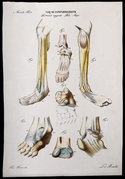 Examples of foot deformities: skeletal detail, numbered for key