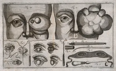 Eye diseases and surgical instruments