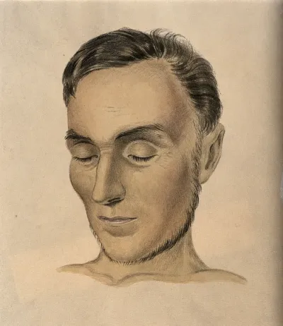 Face of a man suffering from Addison's disease