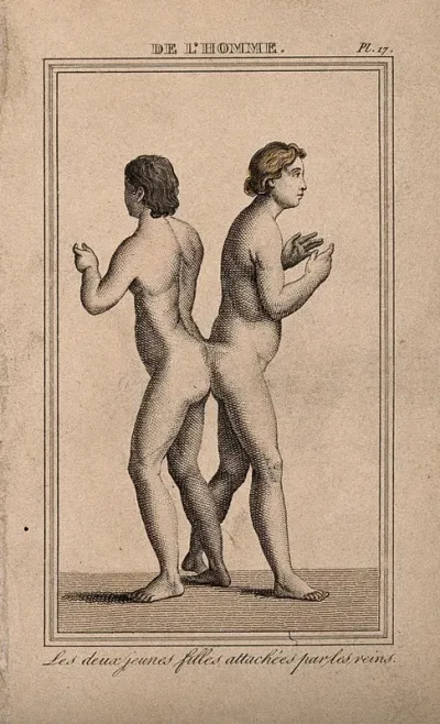 Female conjoined twins, joined at the small of the back