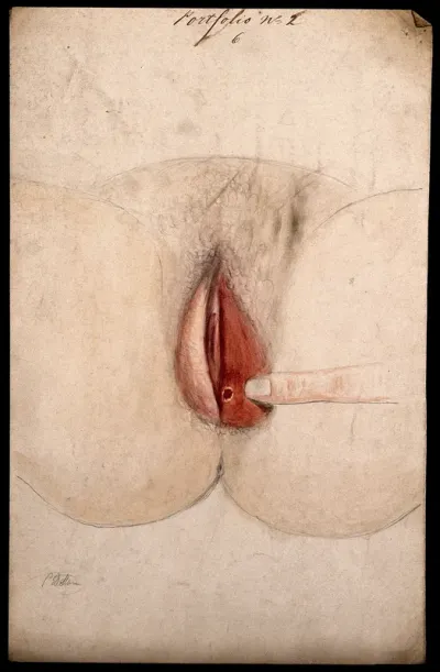 Female genitalia held open by a finger to show an area of diseased tissue