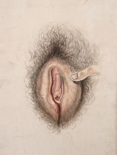 Female genitalia held open by a finger to show diseased tissue