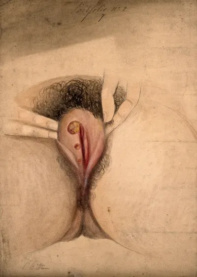 Female genitalia held open by the fingers to show an area of diseased tissue
