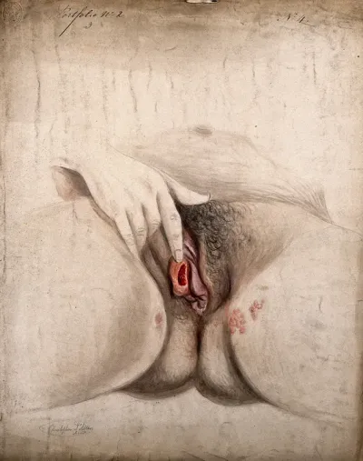 Female genitalia held open by the hand to show diseased tissue, with clusters of sores at the top of the thighs to each side