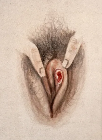 Female genitalia held open by two fingers to show an area of diseased tissue