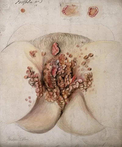 Female genitalia showing severely diseased tissue; and details of sores on the body