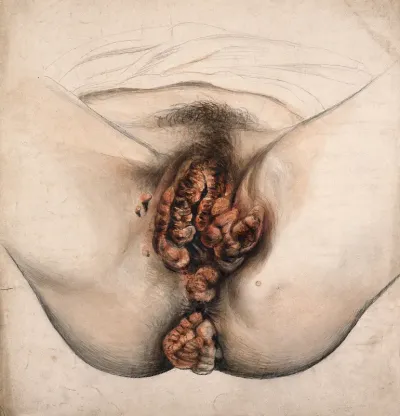 Female genitalia showing severely diseased tissue from the pubis to the anus