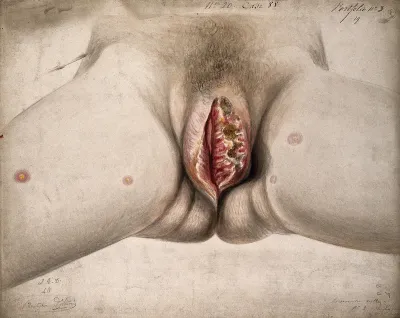 Female genitalia showing severely diseased tissue of the labia, and some sores on the thighs