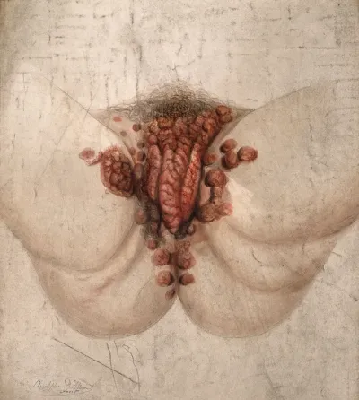 Female genitalia showing severely diseased tissue spreading on to the thighs and anus