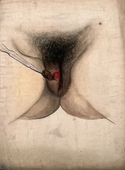 Female genitalia with an area of diseased tissue: a surgical instrument is shown extracting part of the diseased area
