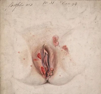 Female genitalia with areas of diseased tissue, and clusters of sores on the top of the thighs to each side