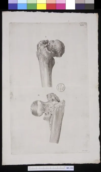 Femur with infection