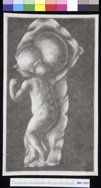 Fetus with hydrocephalus