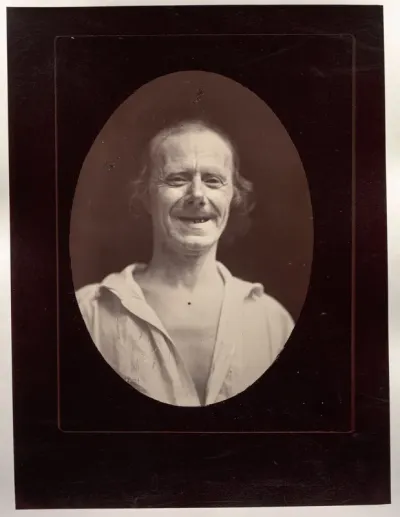 Figure 32: Natural laughter by the voluntary contraction of the two large zygomatics and the lower palpebral orbicularis