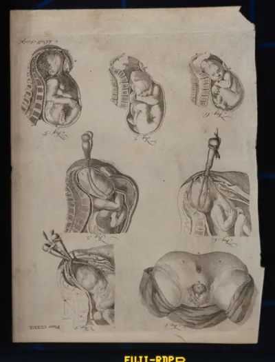 Five diagrams illustrating the birth of a child with the use of forceps