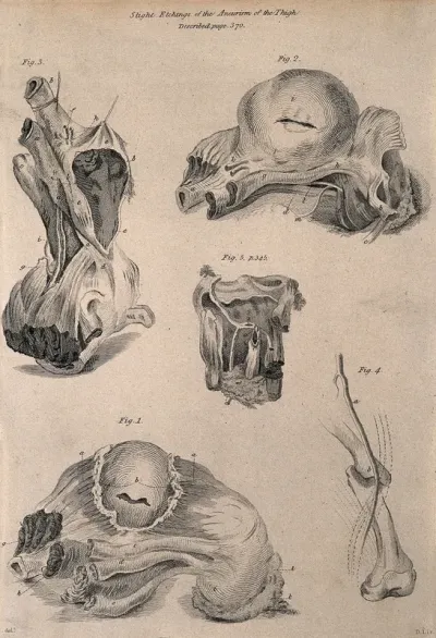 Five examples of aneurisms of the thigh, lettered for key
