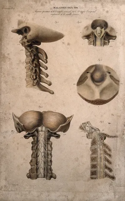 Five sections of diseased bone, numbered for key