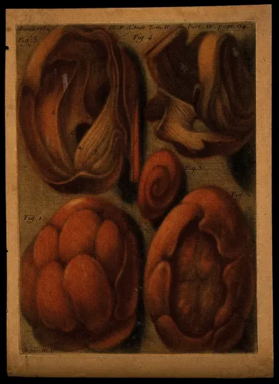 Five tumours in various states of dissection