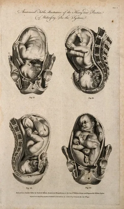 Foetuses in utero: four figures showing cross-sections of a foetus in various positions in the uterus
