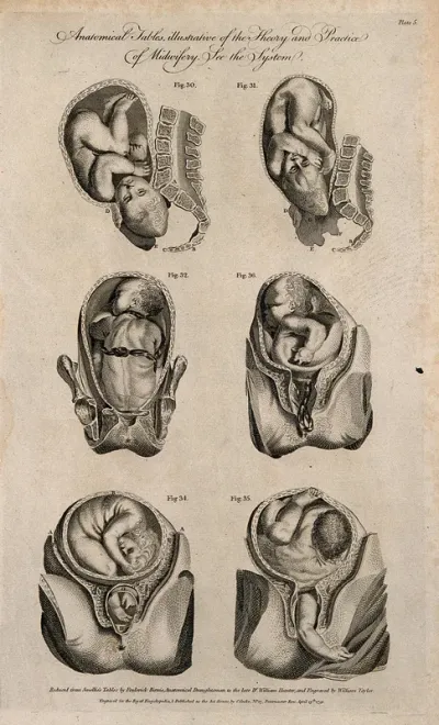 Foetuses in utero: six figures showing cross-sections of foetuses in various positions in the uterus prior to and during birth