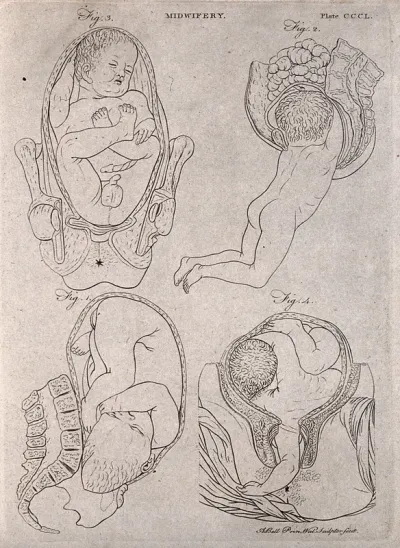 Four diagrams illustrating difficult births