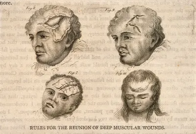 Four diagrams illustrating heads with severe wounds, demonstrating how to stitch the skin back together properly