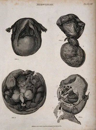 Four diagrams of the abnormal female uterus