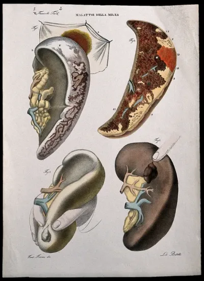 Four examples of diseased spleen, numbered for key