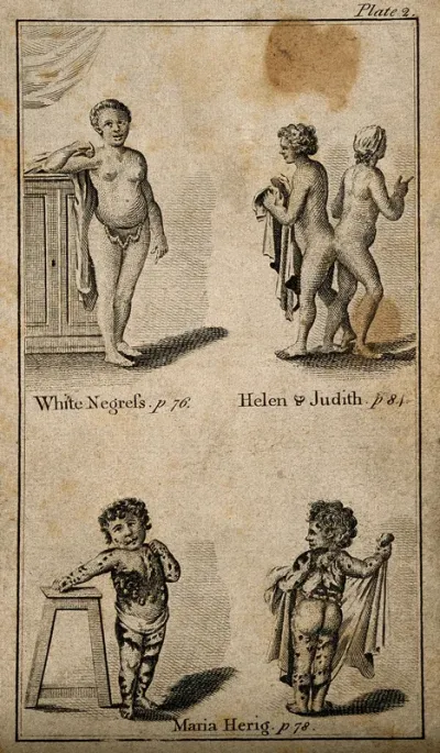 Four figures: Geneviève, an albino woman of African descent, with white instead of black skin; the conjoint twins Hélène and Judith; and Maria Herig who had a skin disease