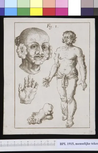 Four images of a man with tumors all over his body