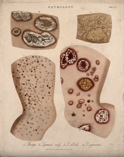 Four patches of skin showing types of skin disease