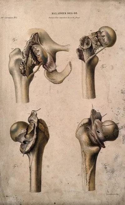 Four sections of diseased bone, numbered for key
