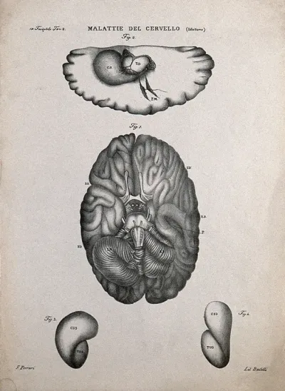Four sections of diseased brain, numbered for key
