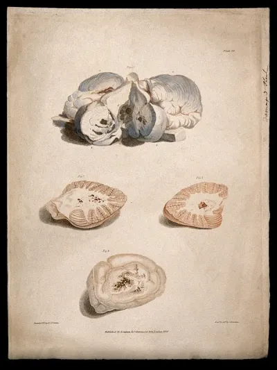 Four sections of diseased brain
