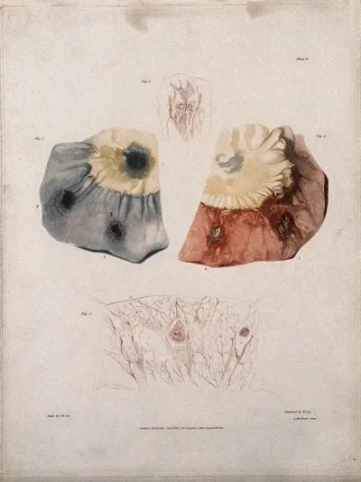 Four sections of diseased intestine