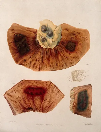 Four sections of diseased intestines