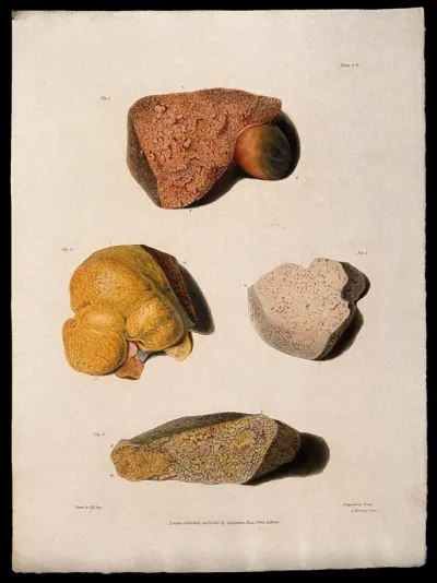 Four sections of diseased liver