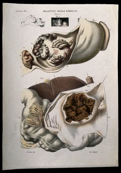 Four sections of diseased stomach (cancer), numbered for key
