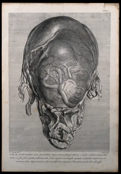 Front view of a pregnant uterus, taken from a woman who died of 'a flooding' in the ninth month of pregnancy
