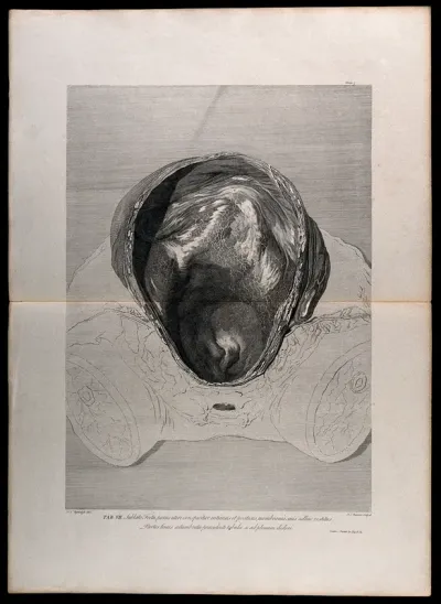 Front view of the cavity of the uterus, after the removal of a foetus: the investing membranes still adhering