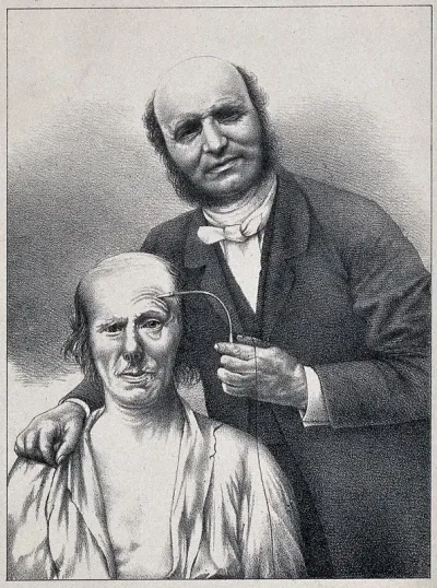 Guillaume Benjamin Amand Duchenne de Boulogne stimulating a patient's facial muscle with a faradic current