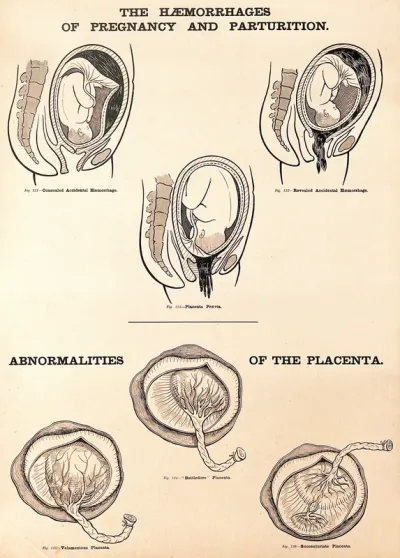 Haemorrhages of pregnancy and parturition, and abnormalities of the placenta