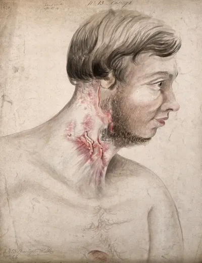 Head and chest of a man with a disease affecting his neck, seen in profile