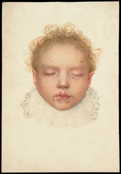 Head of a child with closed eyes and skin disease on the face